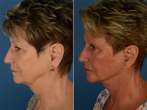 neck lower face lift 3