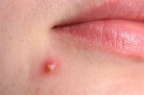 Acne - treatments, causes and prevention | healthdirect