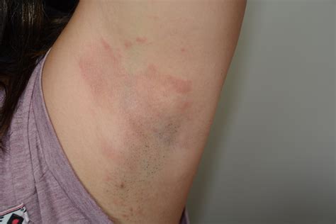 What To Do When Deodorant Causes Rash at Gayla Wilson blog