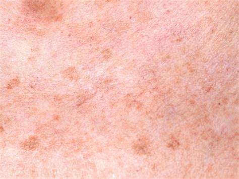 rutina  evitar  eliminar manchas en tu piel