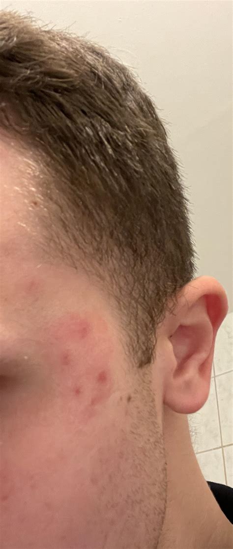 [Acne] How to remove the redness and the spots? They were huge pimples