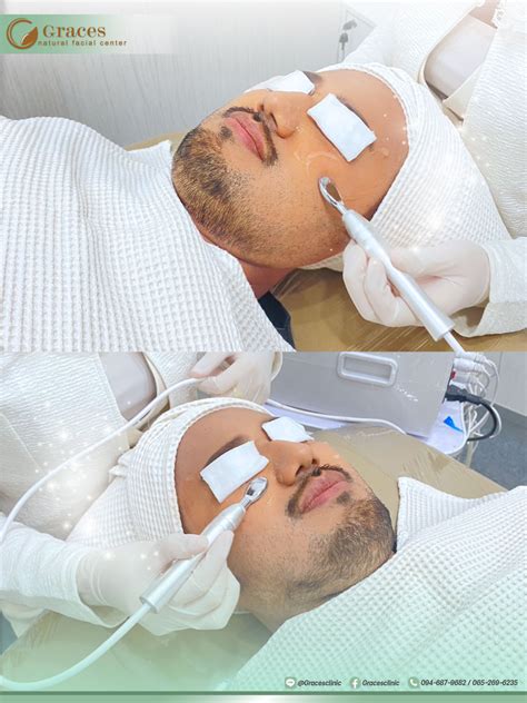 RF EYE LIFTING (Radiofrequency Therapy) “ | Graces