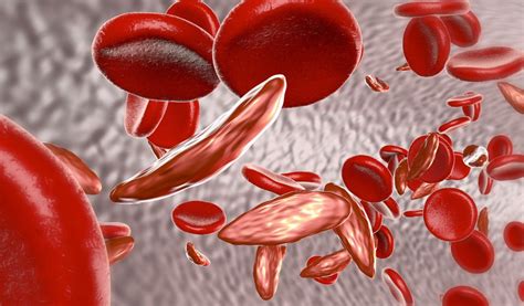O'que É Anemia Falciforme - Anemia falciforme: o que é, sintomas e tratamento