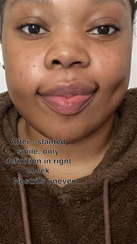 Jaw surgery ruined my face (before/after) : r/jawsurgery