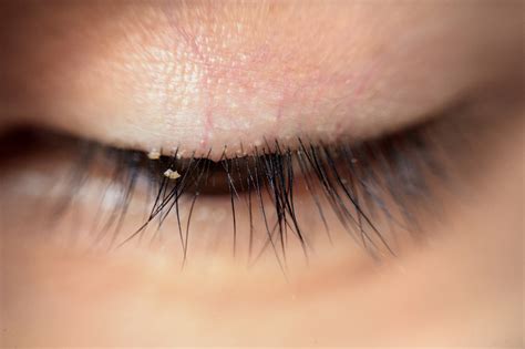 demodex human face 3