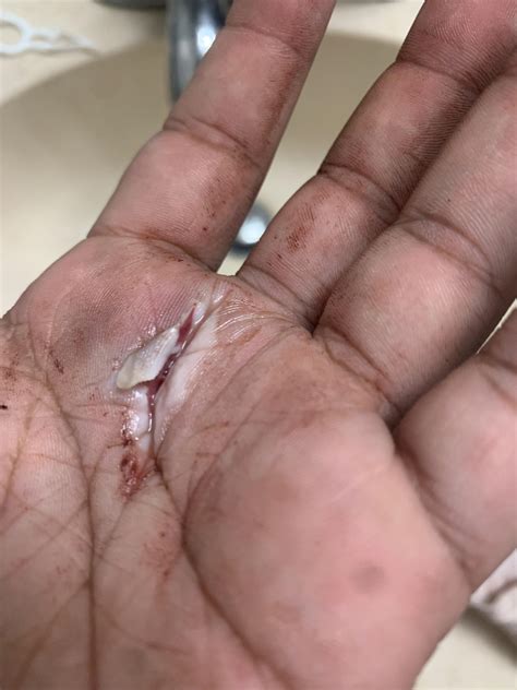 Does this need stitches? : r/medical