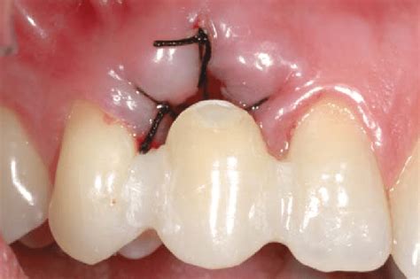 crown fixed  composite resin  root extraction