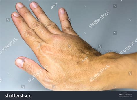 Swollen Male Hand Stock Photo 456744238 | Shutterstock