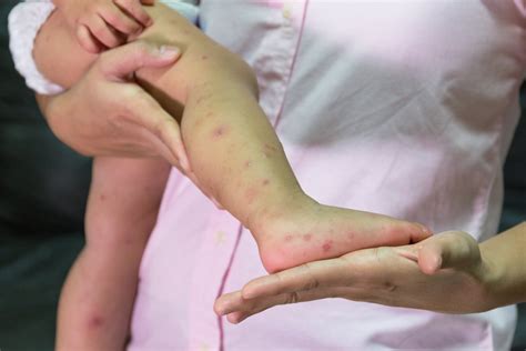 hand mouth foot disease home remedies