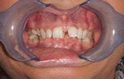 Inman Aligner Before and After - Boutique Dental 23