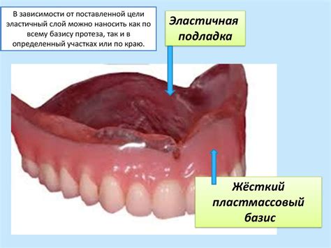 Съёмные протезы с различными базисами - презентация онлайн