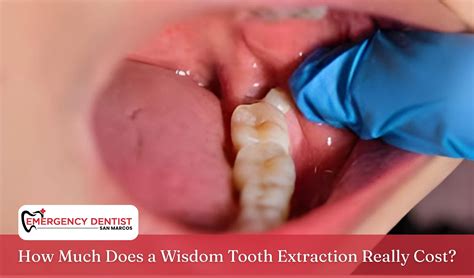 wisdom tooth extraction  cost