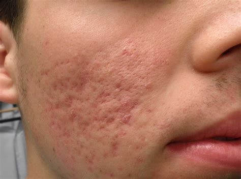 Rolling Acne Scar