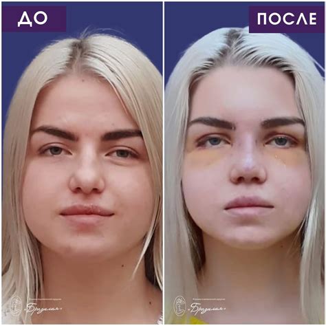 Ринопластика, пластика носа цена и отзывы в Калининграде