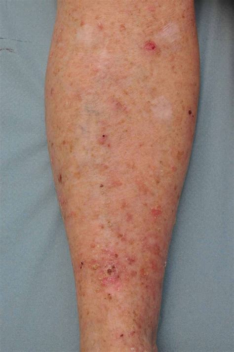 Skin cancer images | What does it look like? | Skin Cancer Clinic