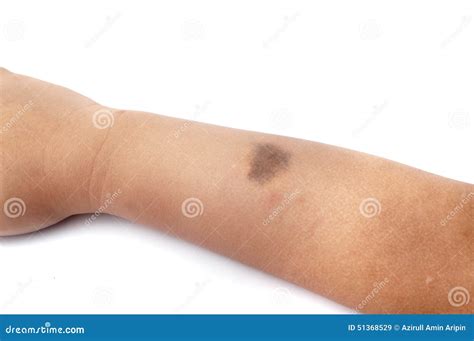 Birth Mark on the Right Hand Stock Image - Image of cancer ...