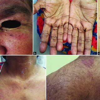 (a) Heliotrope rash (periorbital erythema and edema) with ulceration ...