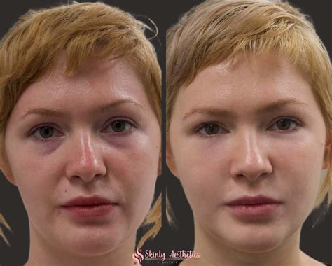 Under Eye Fillers - Before & After Results at Skinly