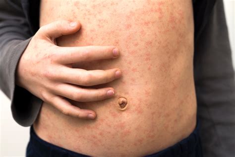 pregnant women with measles 1