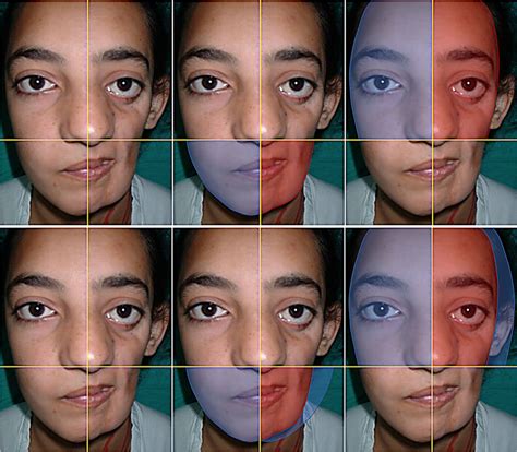 Computerized photogrammetric facial symmetry analysis with anatomical ...