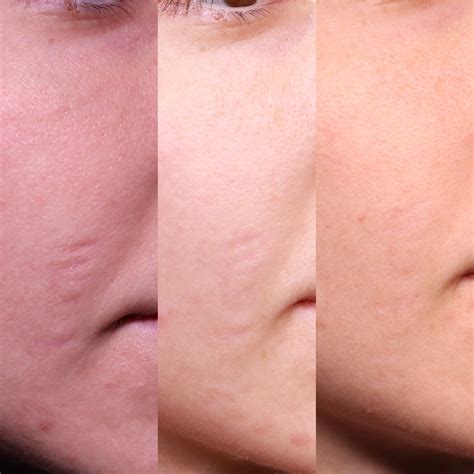 Atrophic Scar Treatment Before and After - Scar Healing Institute