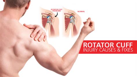 rotator cuff tear symptoms treatment  exercises