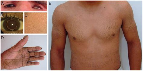 Clinical features of patients. (A) Patient D1 with erythema of the face... | Download Scientific ...