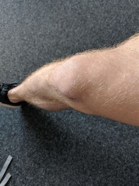 Knee pain, front inner side : r/Velo