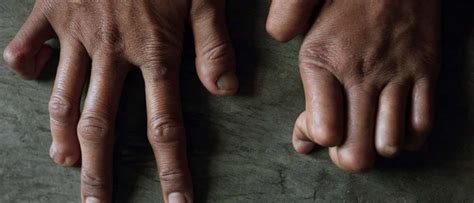 mengenal kusta lebih dekat