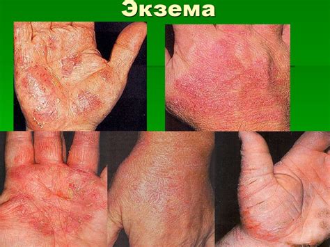 Аллергодерматозы - презентация онлайн