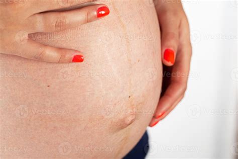 Stretch marks on the abdomen of a pregnant girl, a bulging navel
