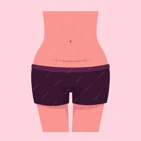 Free Vector | Flat cesarean section illustration