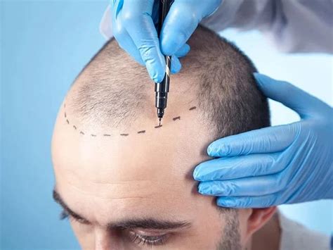 find  top hair transplant cosmetic clinic