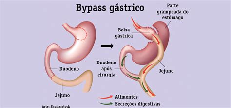 Como Funciona A Bariatrica