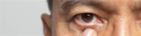 cataracts  diagnosis treatment options