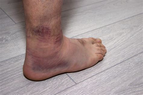 how long does a dislocated ankle take to heal