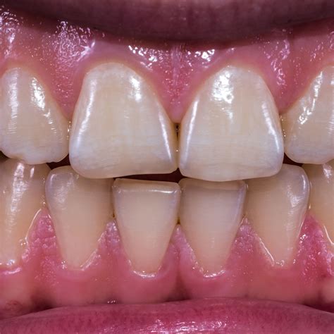 What Is Dental Occlusal Adjustment at Angelina Luttrell blog