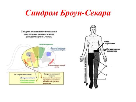 Спинной мозг. Синдромы поражения - презентация онлайн
