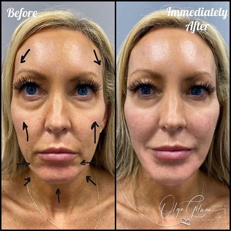 Before After Thread Lift Procedures Thread Lift Docto - vrogue.co