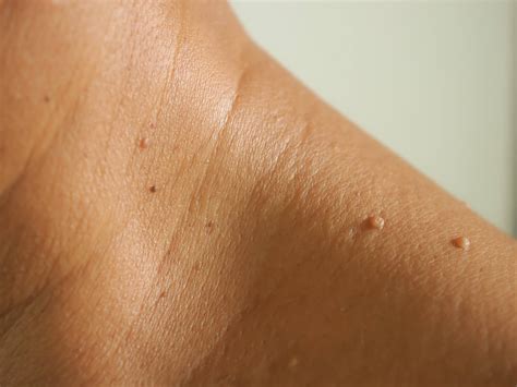 What Are Skin Tags & How To Get Rid Of Them? | Bodyvie