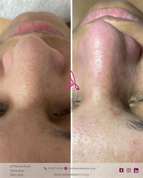 Lakeside - ⚫️Blackheads: What’s Really Lurking in Those Tiny Dark Spots