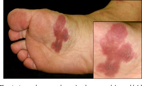 figure    case  eccrine angiomatous hamartoma