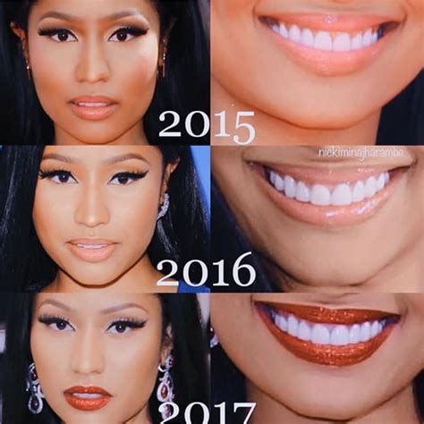 Nicki Minaj Fake Teeth