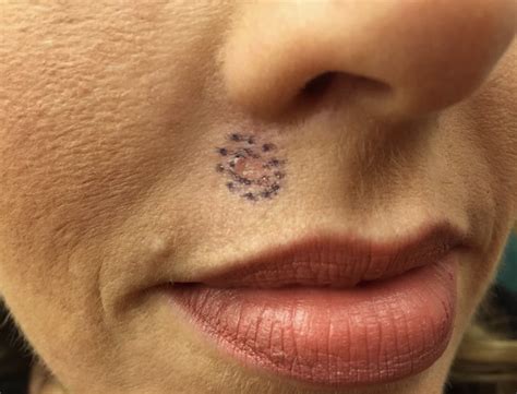 knowing  warning signs  skin cancer    prevent