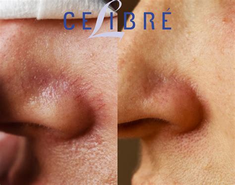 Spider Vein Removal Before and After Pictures