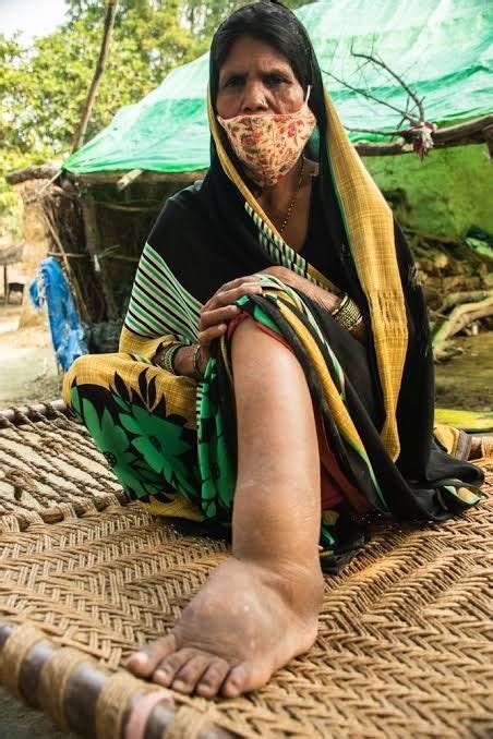 Lymphatic Filariasis UPSC