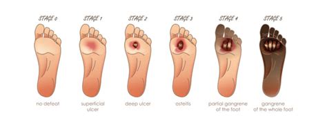 Understanding and Managing Diabetic Foot Pain