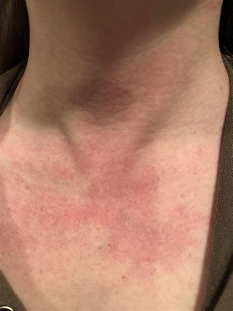 Lupus Skin Rash On Neck - vrogue.co