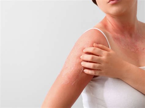 日焼けで「水ぶくれ」ができる原因や、できた際の対処法まとめ