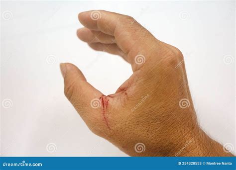 fresh wound   sickle cut   thumb stock image image